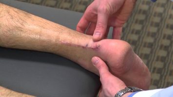 New-Procedure-Helps-Achilles-Tendon-Heal-Faster