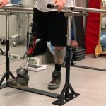 A new type of prosthetic limb snaps onto a metal bar surgically implanted into a patient’s bone, providing more stability and preventing the painful issues many people with amputations experience with traditional socket prostheses.